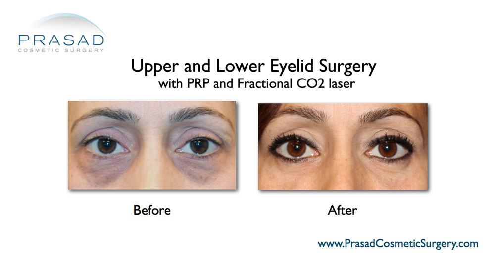 Before and after lower eyelid surgery with PRP and laser treatment on female patient