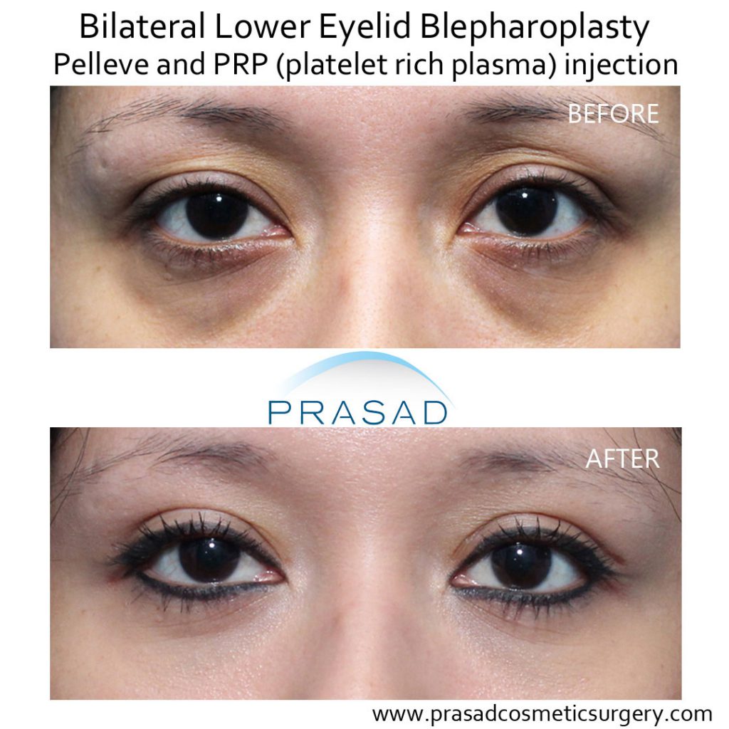 lower eyelid surgery with Pelleve and PRP under eyes before and after treatment