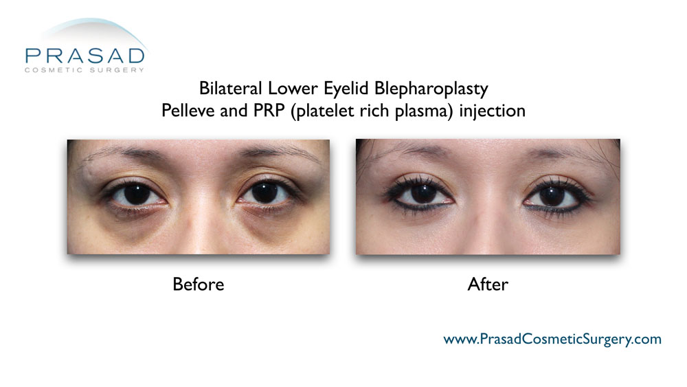 Treating Concurrent Under Eye Puffiness and Hollowness - Prasad Cosmetic  Surgery