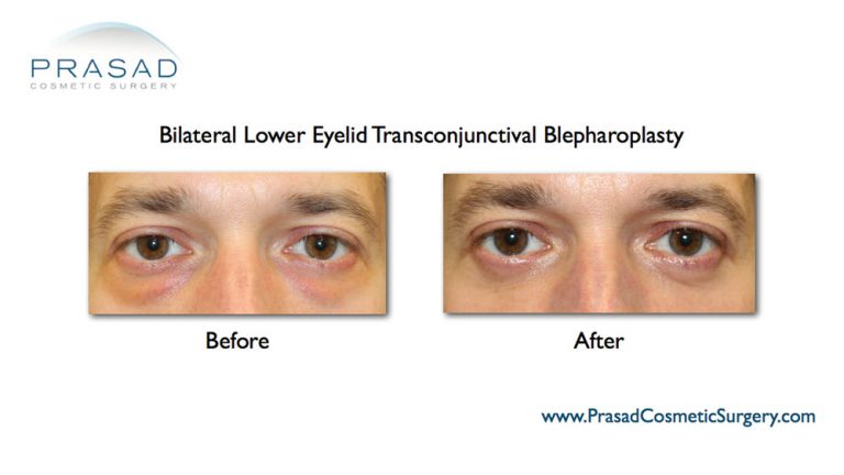 Lower Blepharoplasty Recovery Process | Dr. Prasad Blog