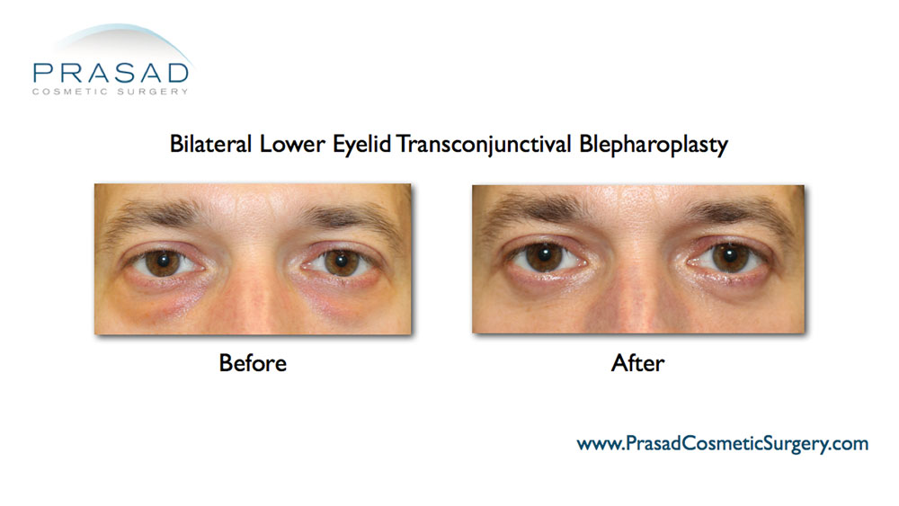 male lower eyelid surgery before and after