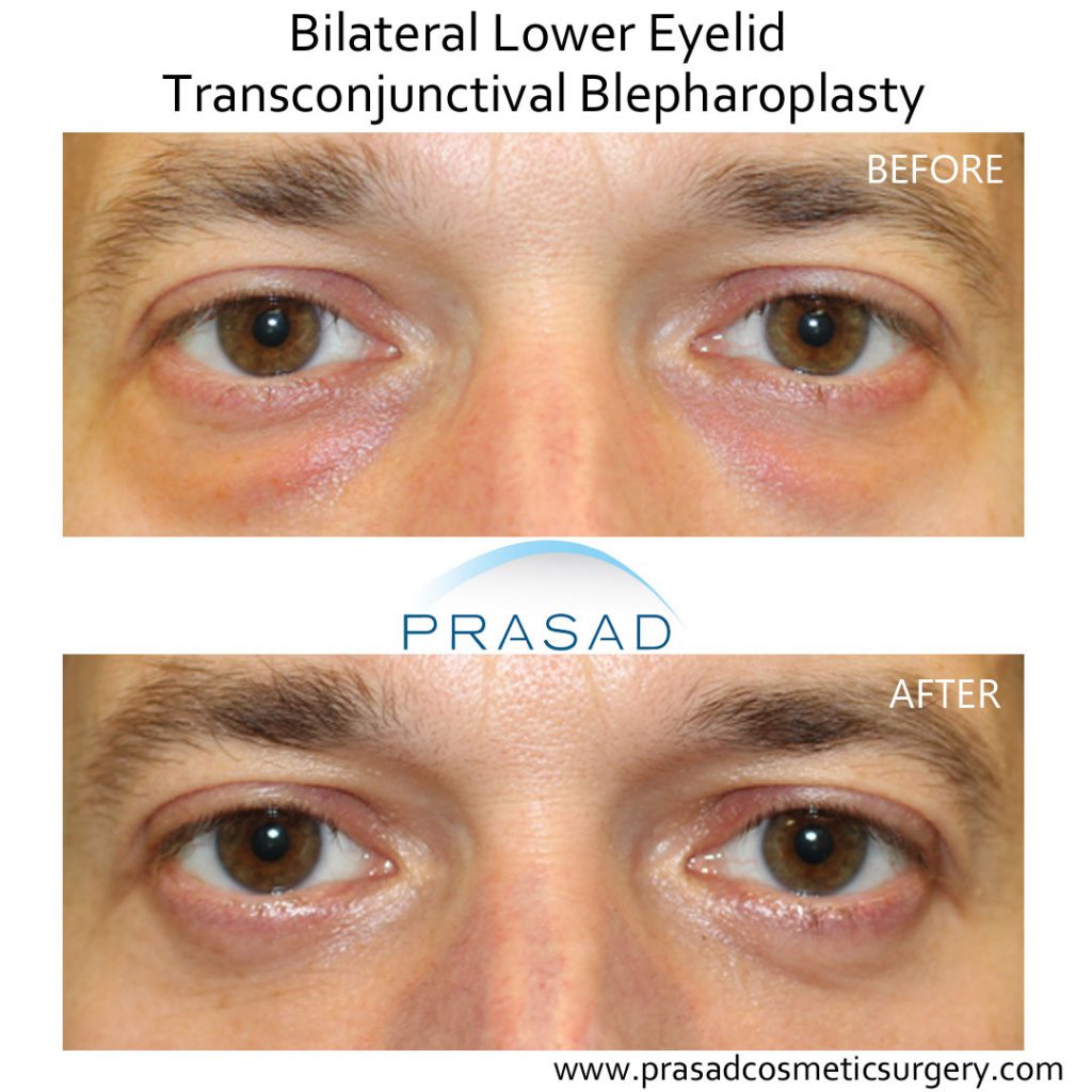 Eyelid surgery deals risks