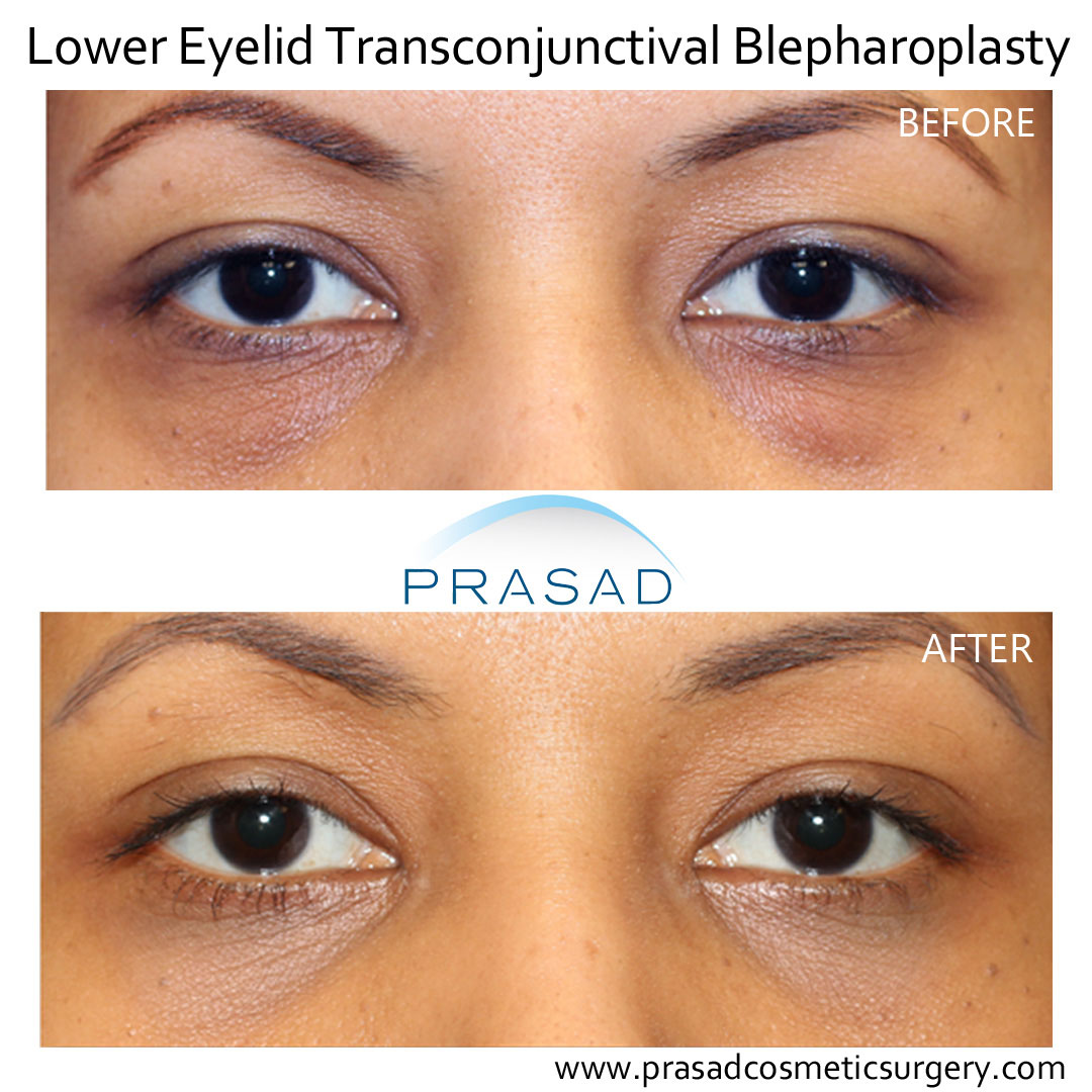 before and after eye lift surgery