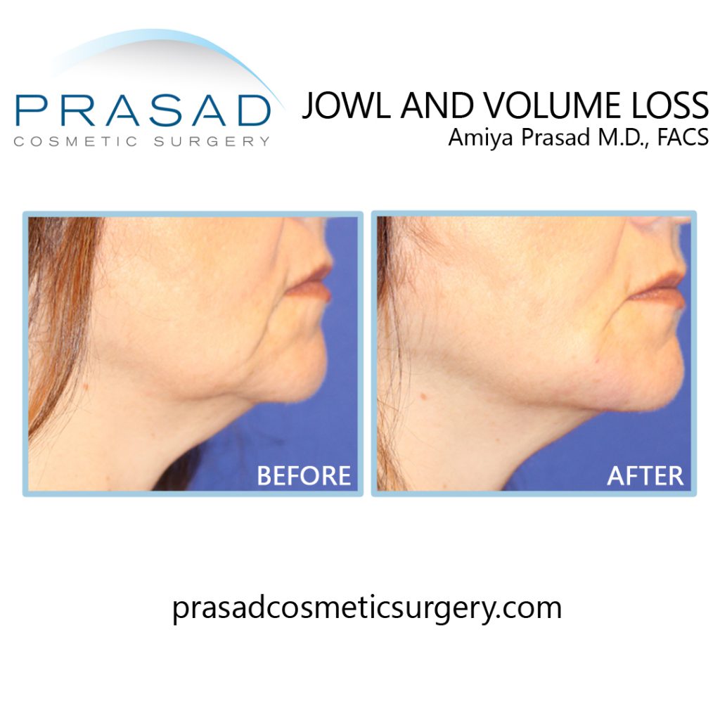 before and after lower face enhancement of mandibular notch and mesolabial fold