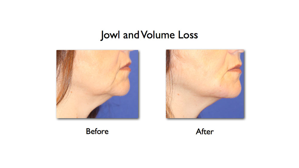before and after lower face enhancement of mandibular notch and mesolabial fold