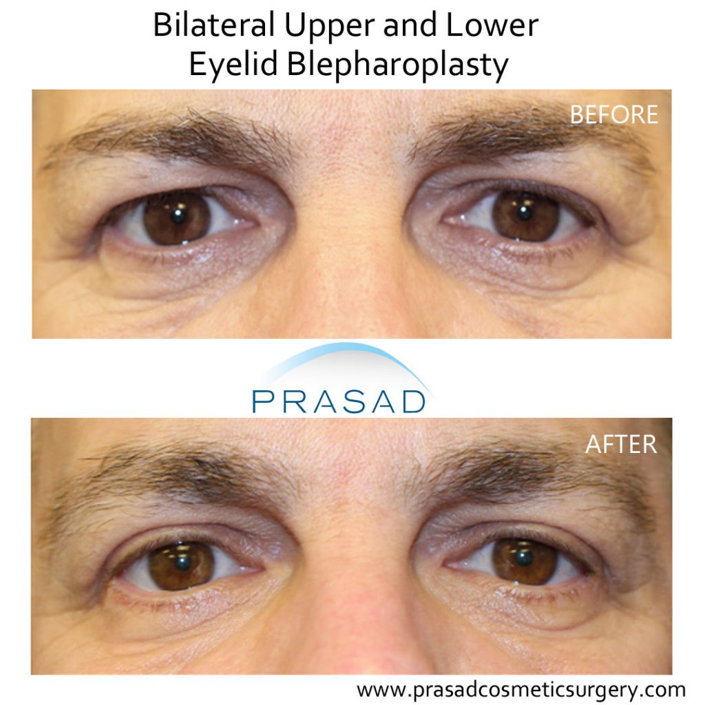 Before and after eyelift surgery recovery, male patient