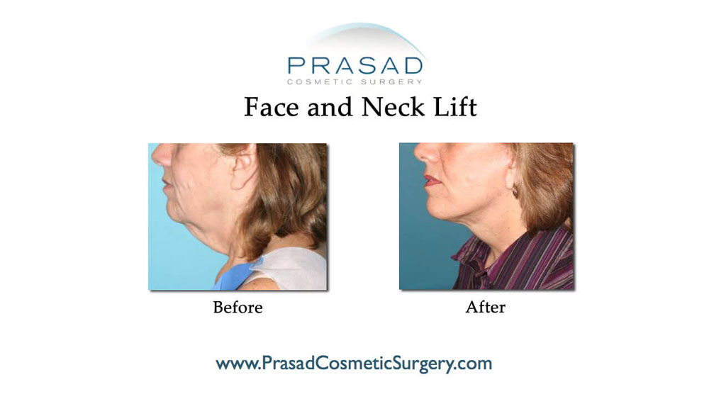 mini facelift results before and after