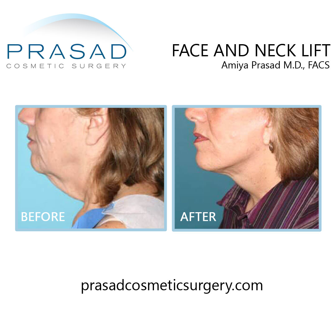 before and mini facelift by Dr Amiya Prasad NY cosmetic surgeon