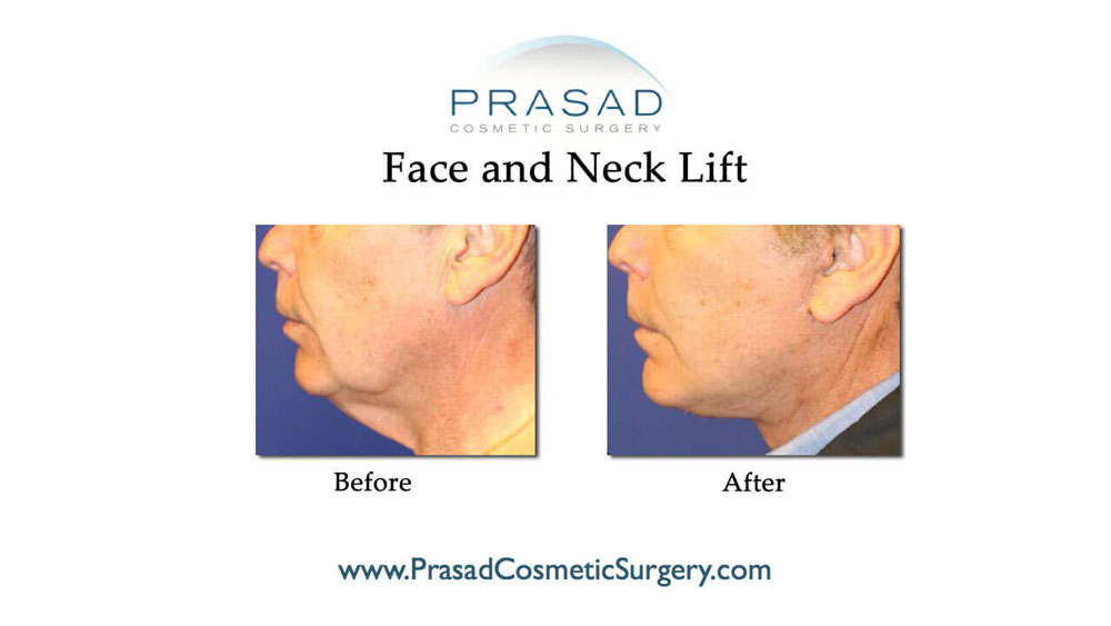 face and neck lift before and after male patient