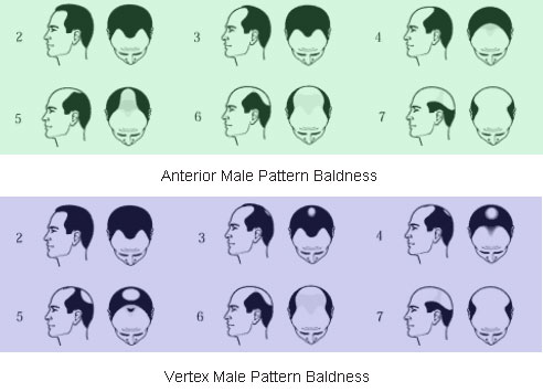 Understanding Hair Loss - anterior and vertex male pattern baldness