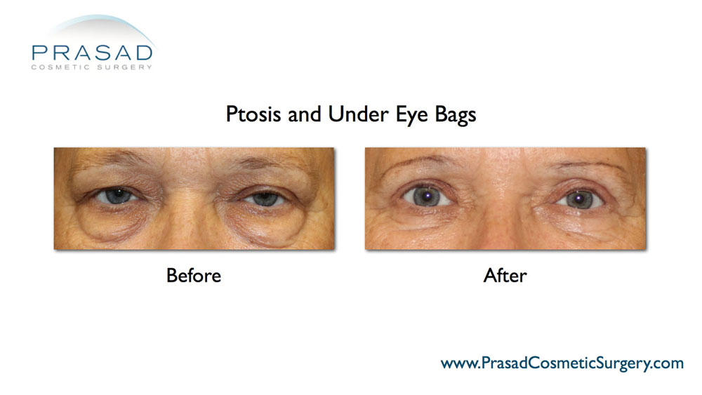plastic surgery bags under eyes before after