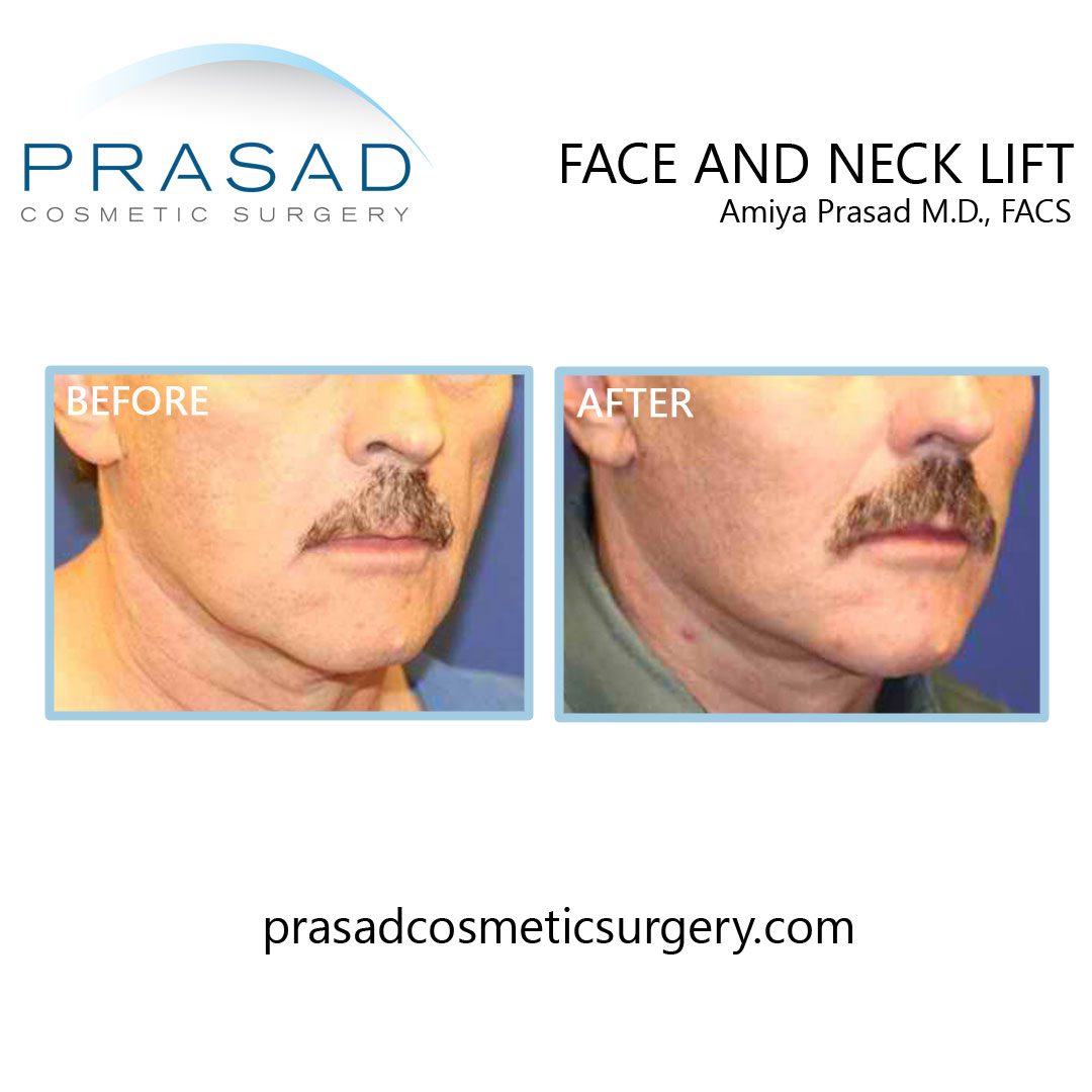 before and after rhytidectomy in NYC by Dr Prasad