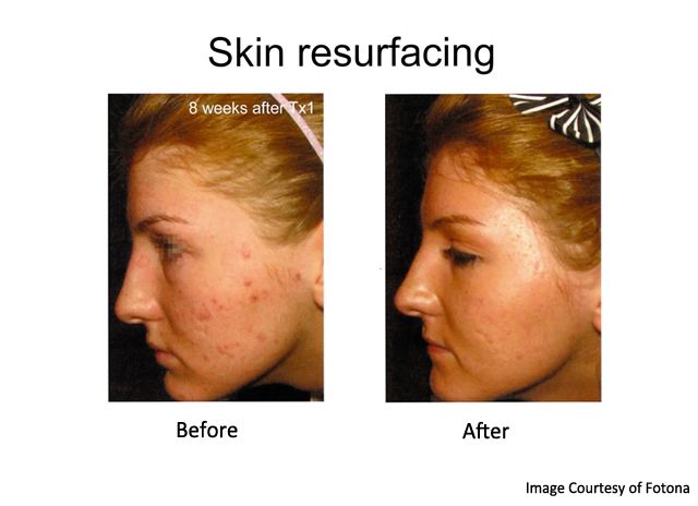 before and after laser treatment for acne scars - female left side view