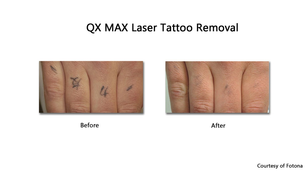 before and after Laser tattoo removal