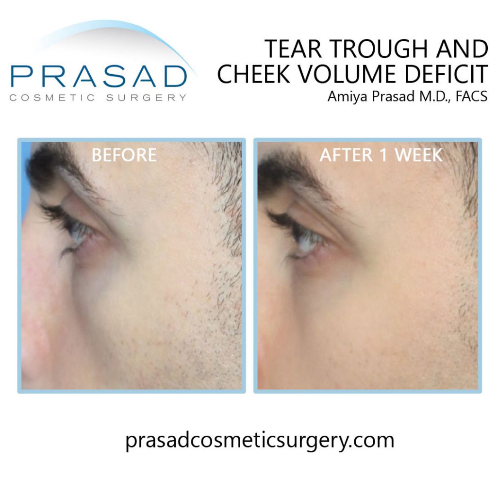under eye filler to the tear trough before and after 1 week results - male patient