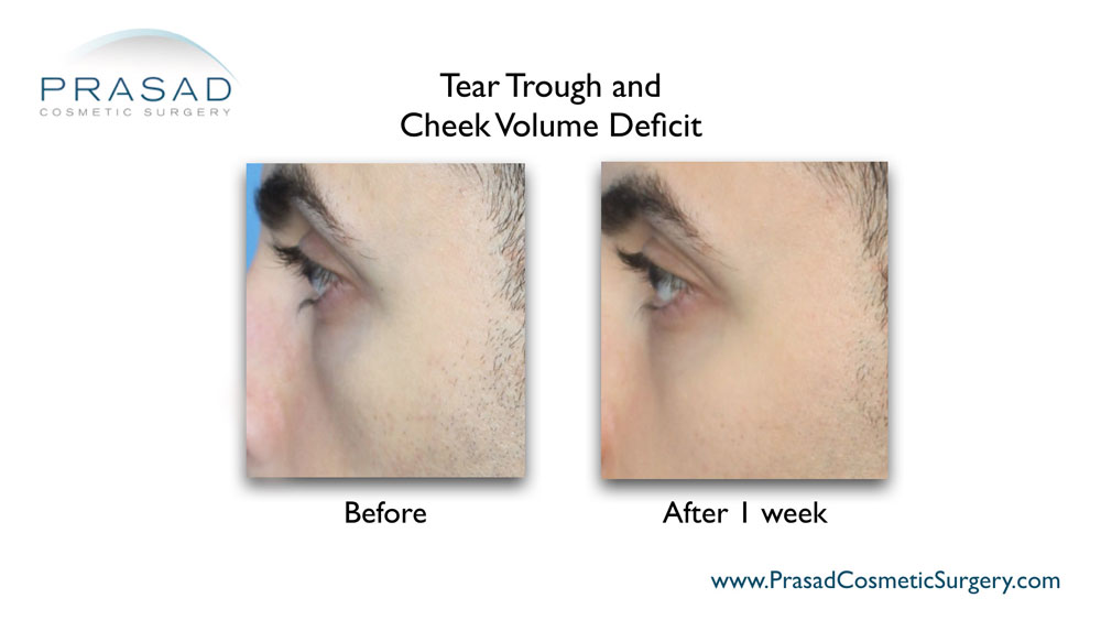 under eye filler to the tear trough before and after 1 week results - male patient