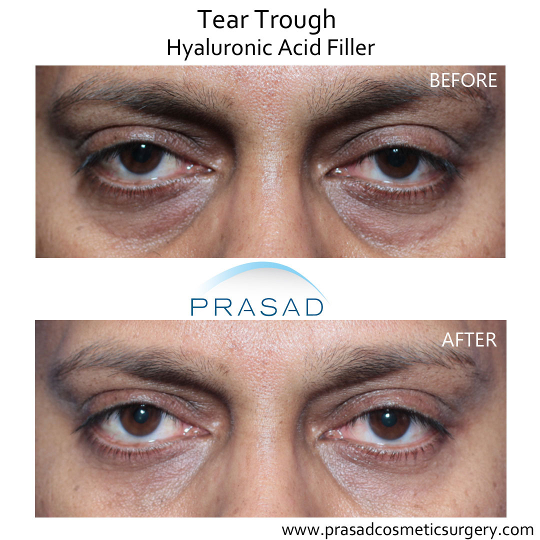 Under Eye Filler For Hollow Eyes Tear Troughs And Eye Bags   Tear Trough Correction With Hyaluronic Acid Filler Closeup 