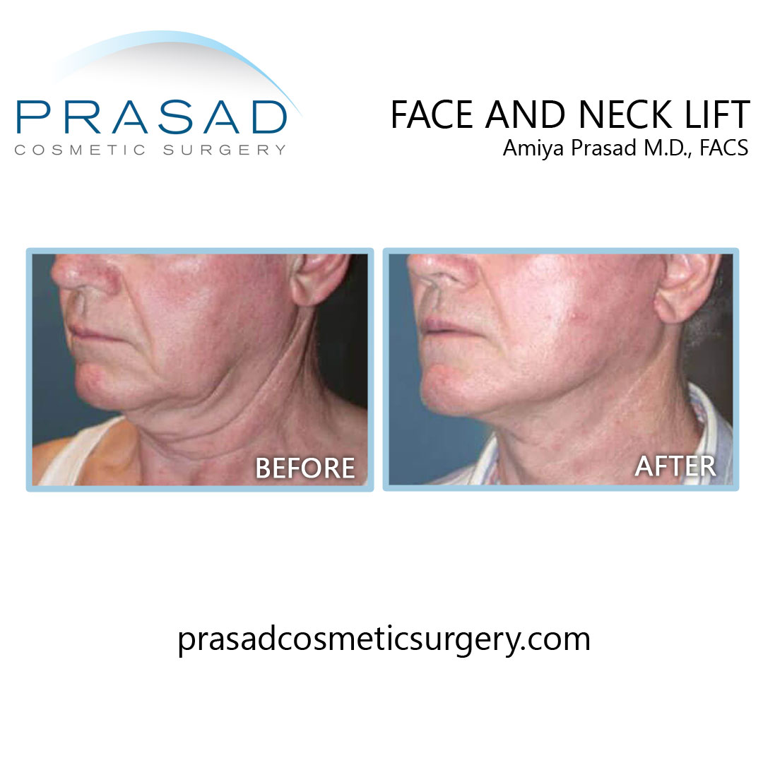 before and after face and neck lift results