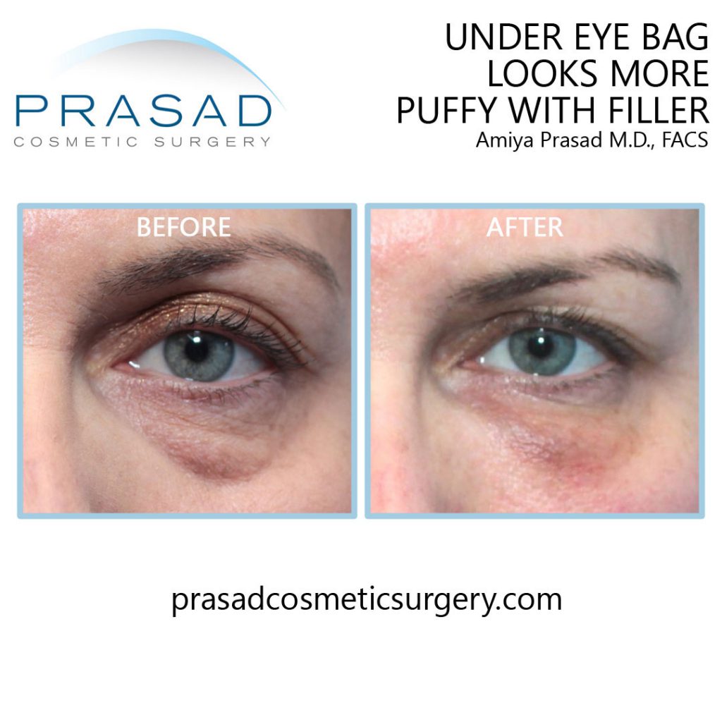 cosmetic fillers under eye bags gone wrong