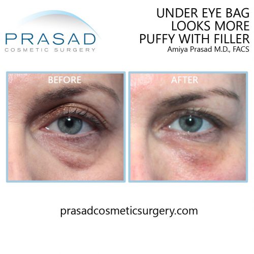 Under Eye Filler for Hollow Eyes, Tear Troughs and Eye Bags