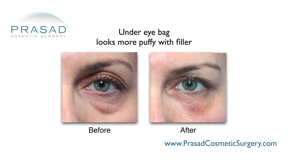 cosmetic fillers under eye bags gone wrong