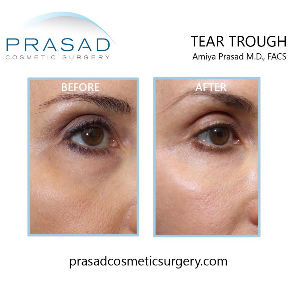 Under Eye Fat Transfer: Possible Complications & Safer Alternative