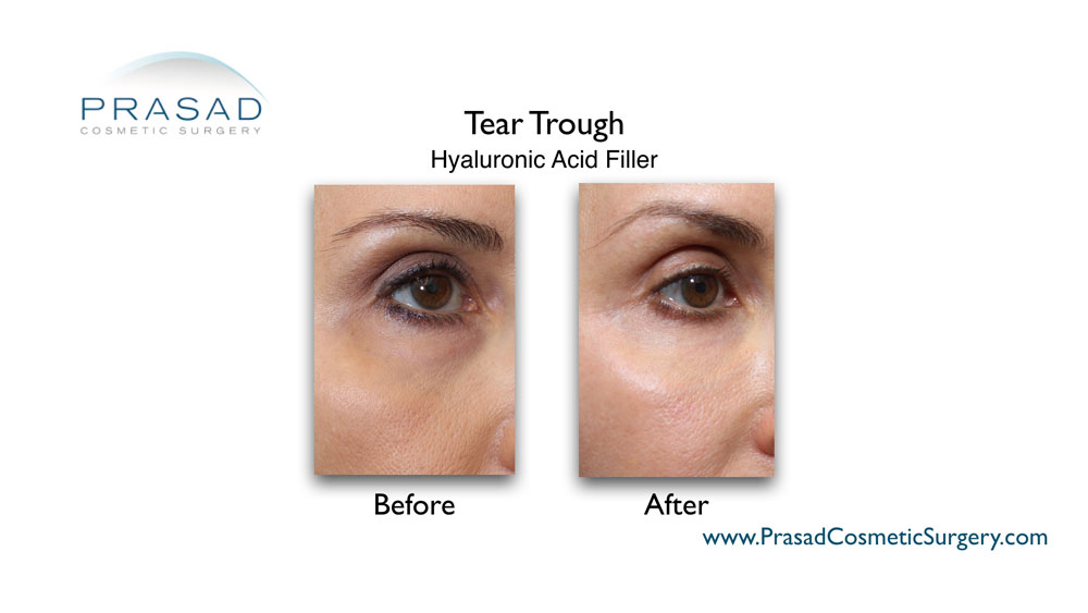 under eye filler injection before and after results