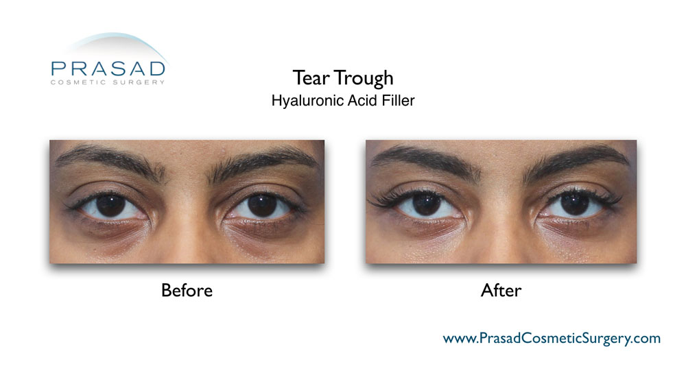 fillers for under eye bags before and after results