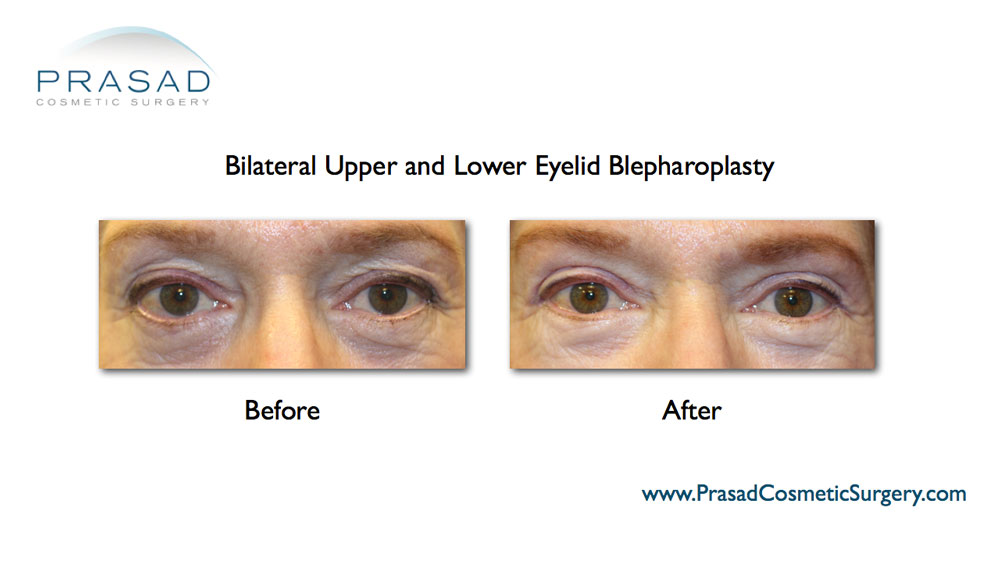 upper blepharoplasty and lower eye lift before and after