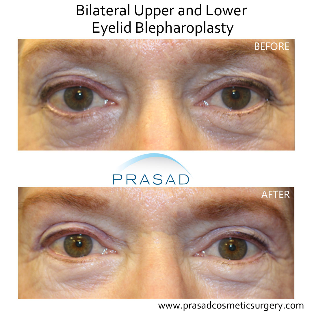 upper and lower eyelid surgery before and after