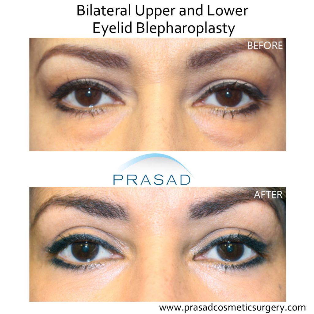 upper and lower eyelid blepharoplasty before and after