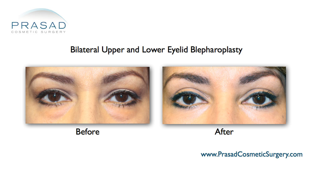 Upper eyelid surgery patient before and after recovery