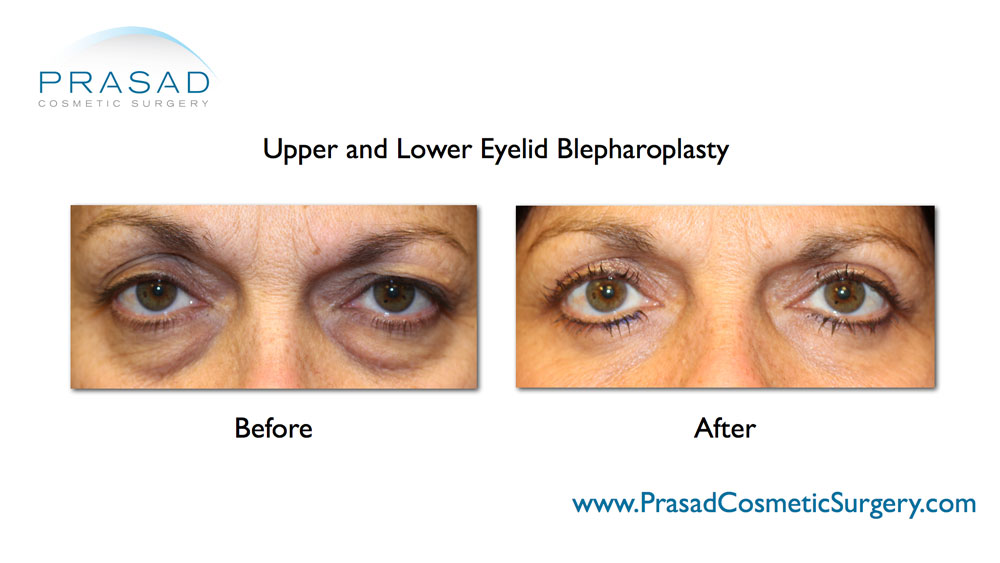 eye lift before and after female