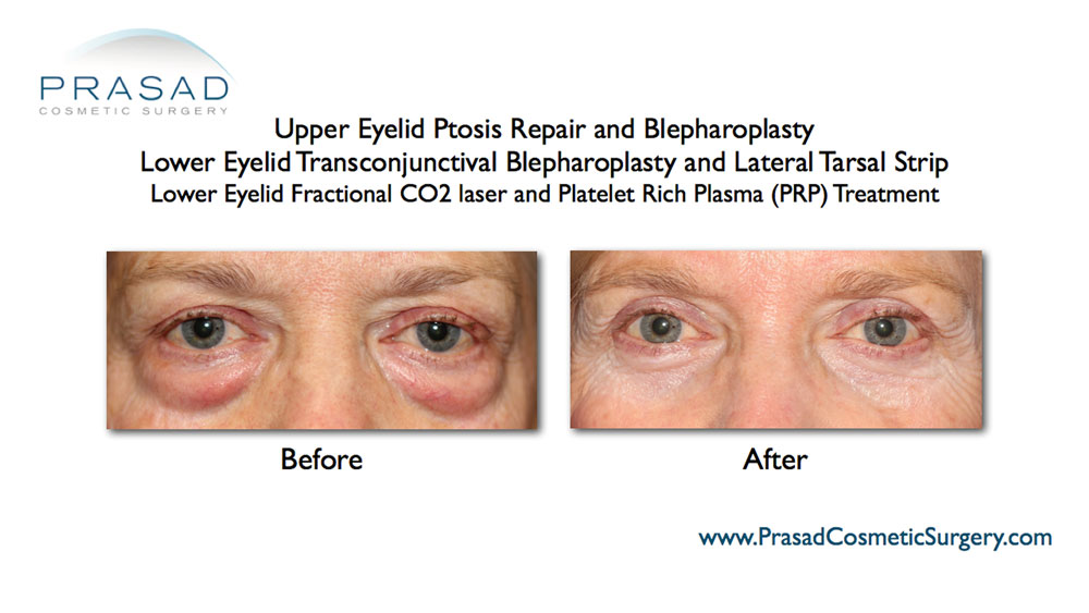 droopy eyelid surgery before and after pictures