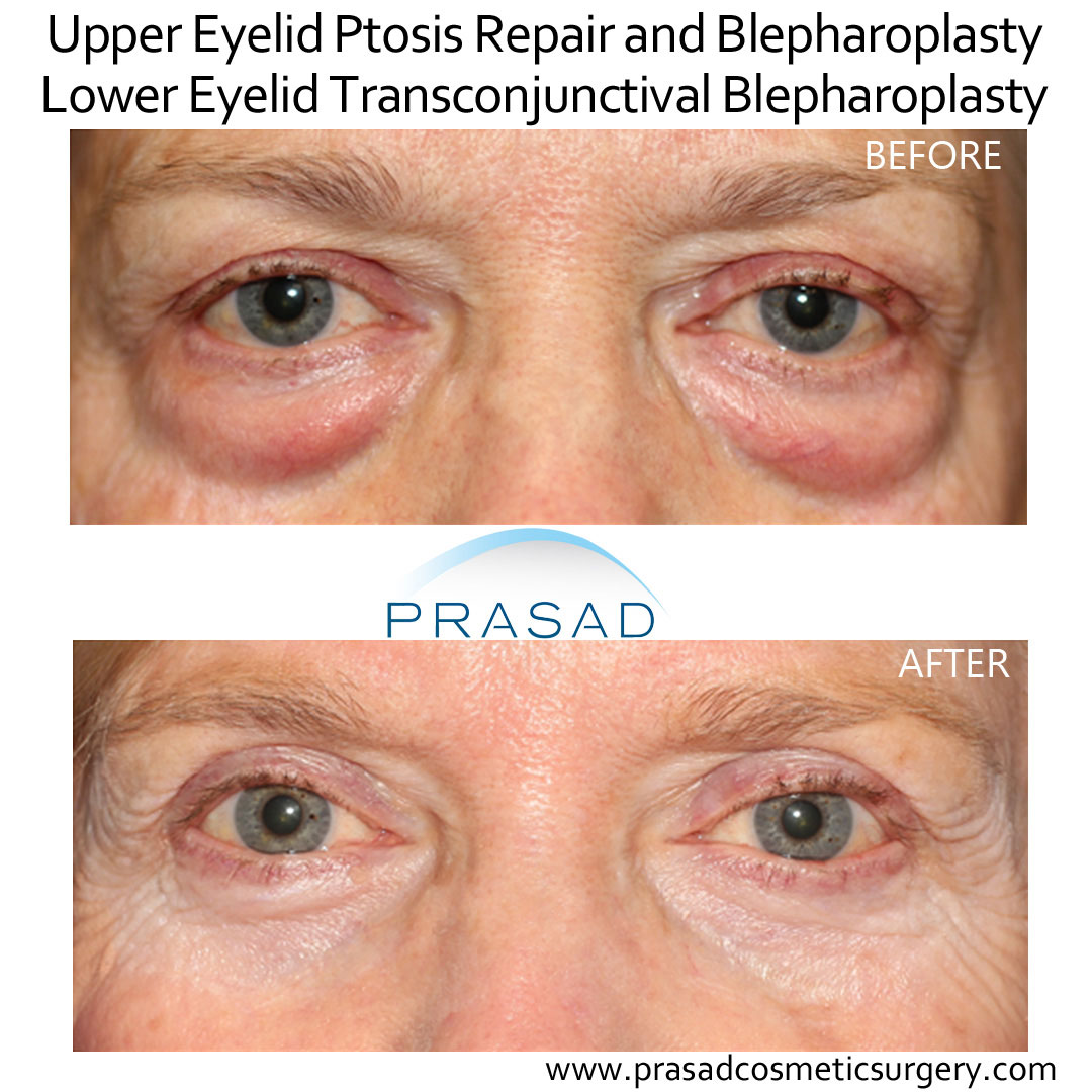 droopy eyelid surgery before and after pictures