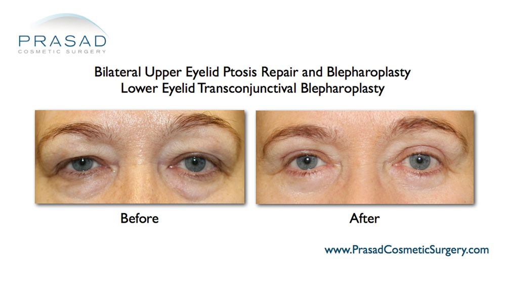 puffy eyes surgery before and after