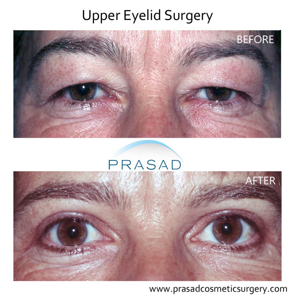 Upper Eyelid Blepharoplasty Patient Before and after surgery