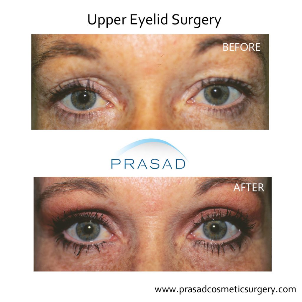 SmartLift Eyelift Patient Before and after surgery