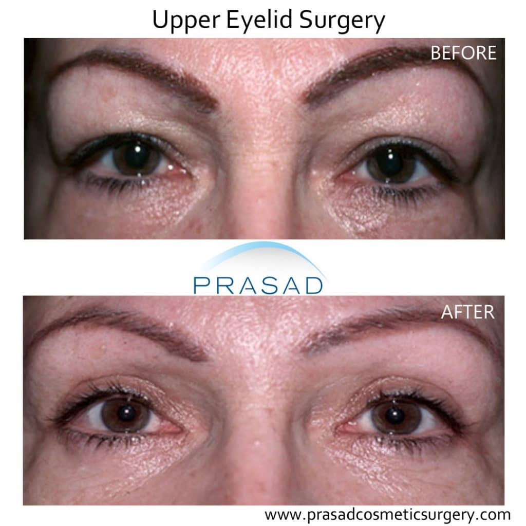 Upper eyelid store