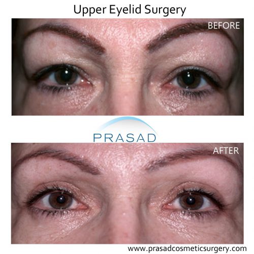 Upper Blepharoplasty / Upper Eyelid Surgery | Dr. Amiya Prasad