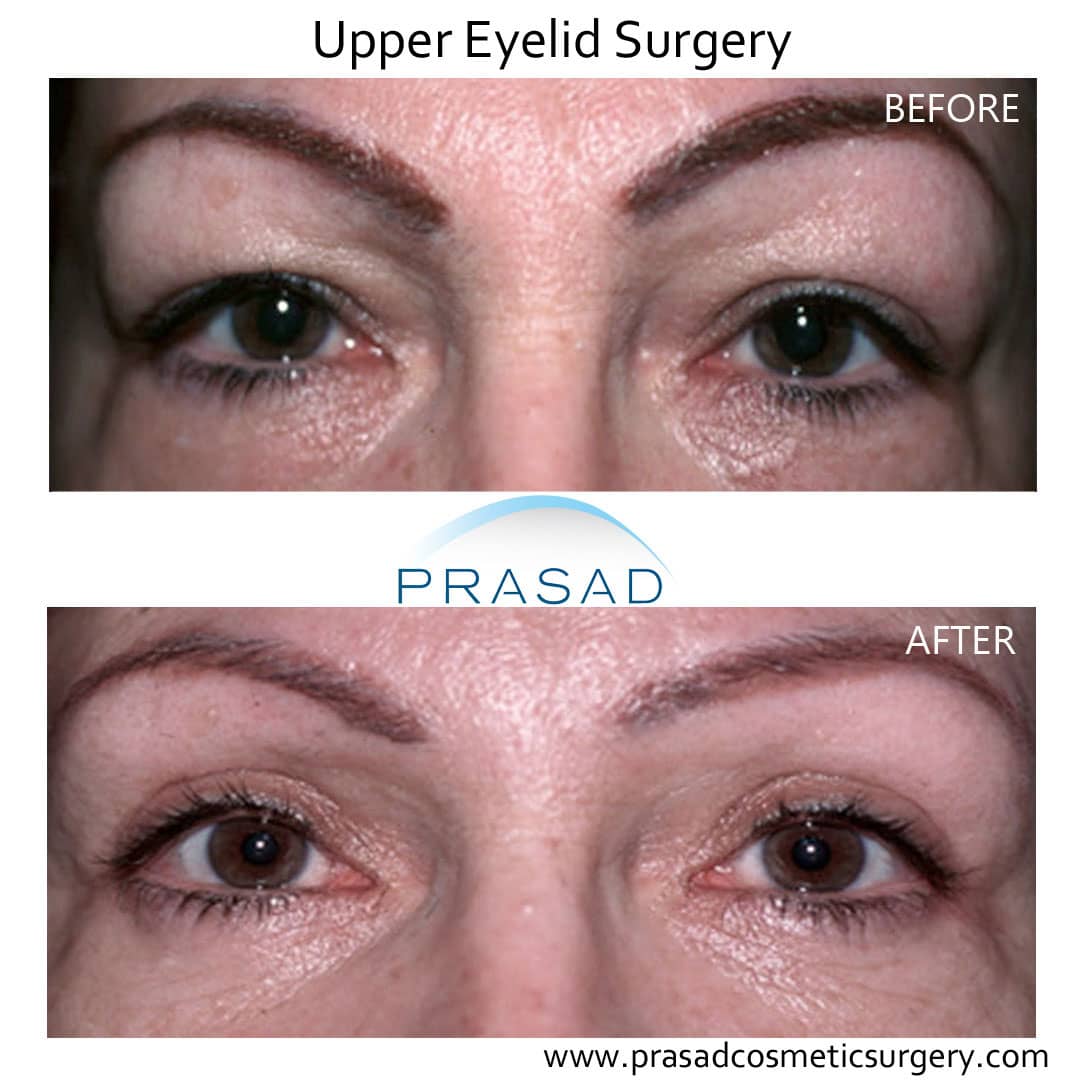 before and after cosmetic Upper Eyelid surgery performed by Dr Prasad