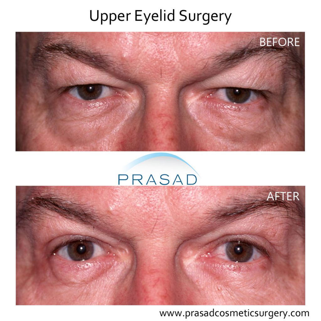 Upper and Lower Blepharoplasty Patient Before and after surgery