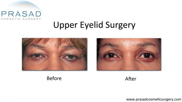 Eye Lift - Upper Eyelid Surgery and Recovery (New York)