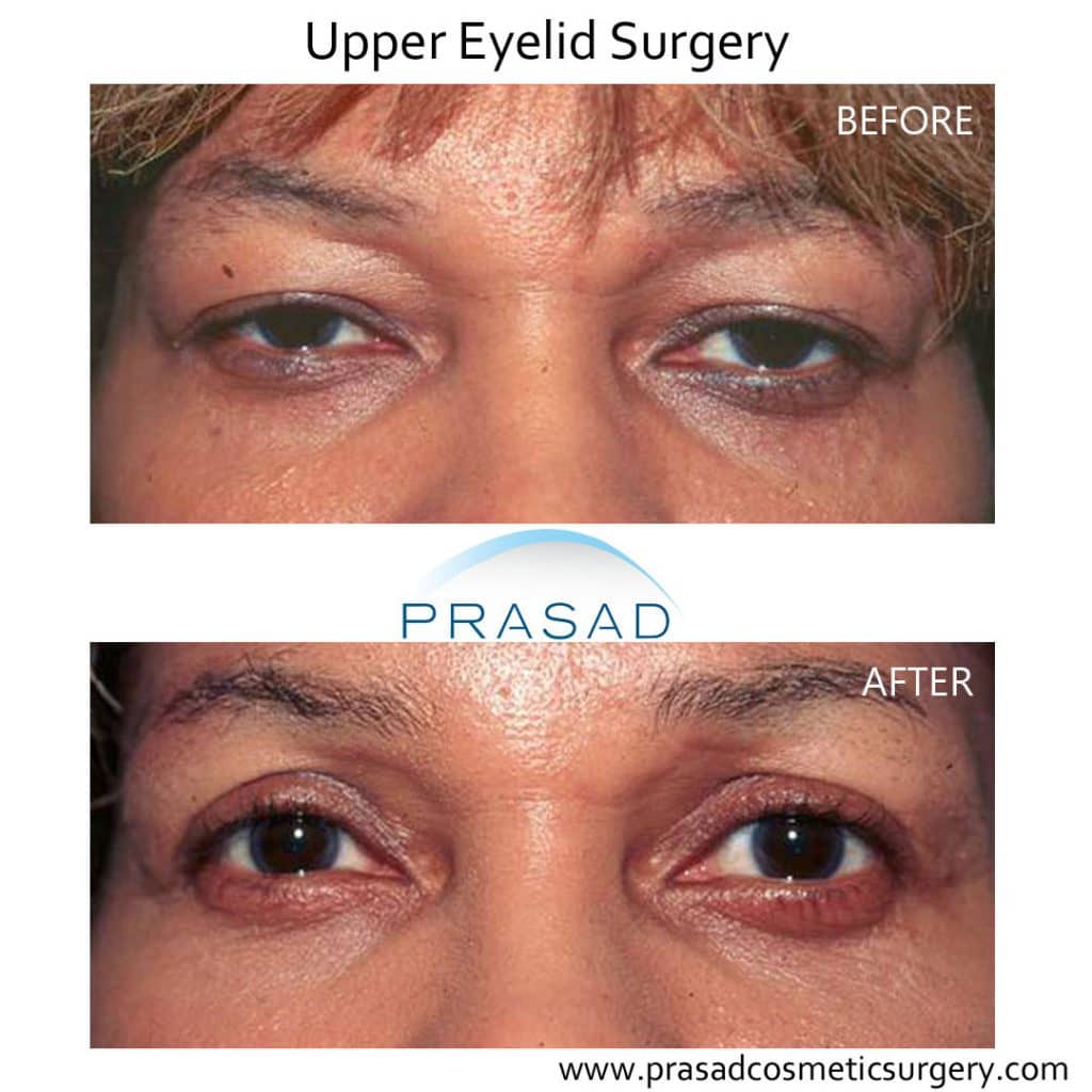 Eyelid surgery results on African-American (Dark Skin) patient