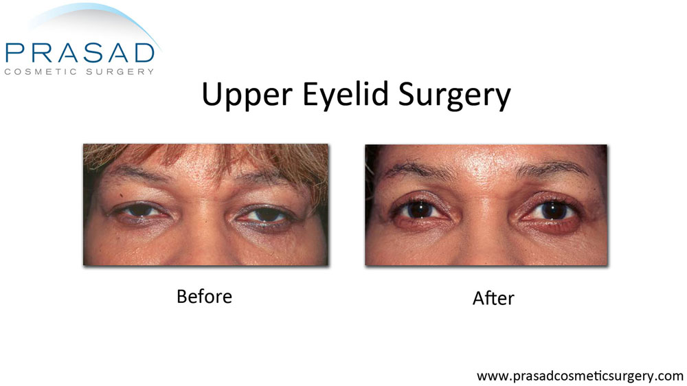 Eyelid surgery results on African-American (Dark Skin) patient