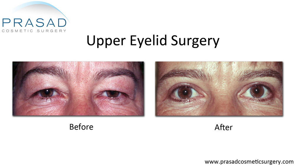 Eyelid deals surgery nyc