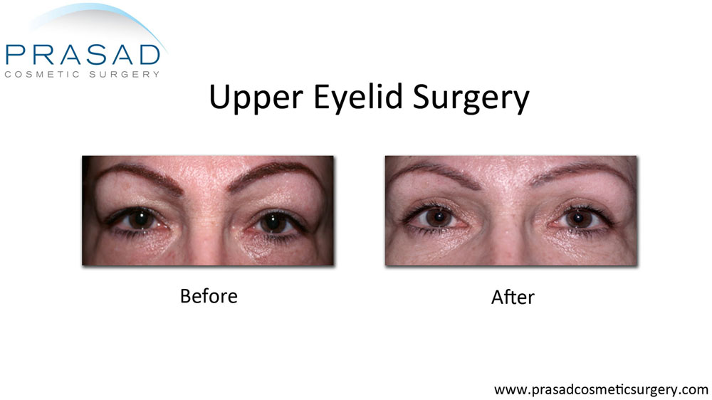 before and after cosmetic Upper Eyelid surgery performed by Dr Prasad