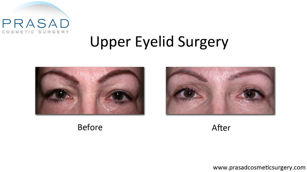 Eyelid Surgery Before and After Photos - Prasad Cosmetic Surgery