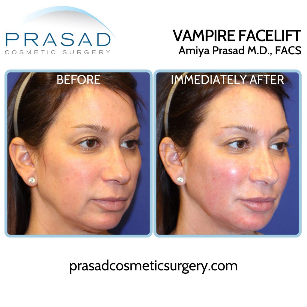 before and immediately after prp face treatment