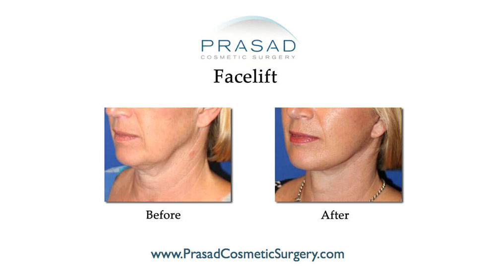 facelift surgery before and after